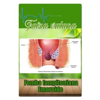 Fomba fampitoniana Hemoroide